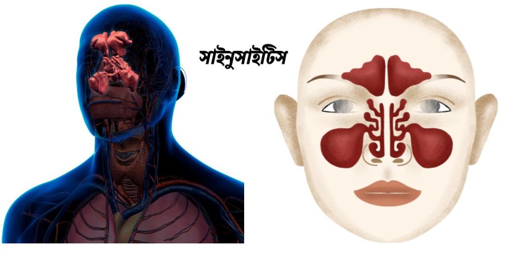 সাইনুসাইটিস (Sinusitis) রোগের কারণ,লক্ষণ ও প্রতিকার।